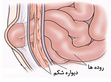  فتق ناف